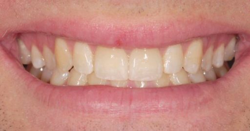 Teeth 2 After Intrinsic Family Dental