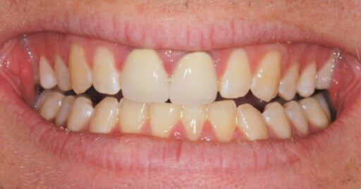 Teeth 2 Before Intrinsic Family Dental
