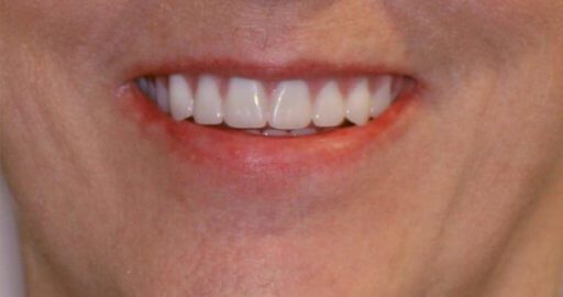 Teeth 4 After Intrinsic Family Dental