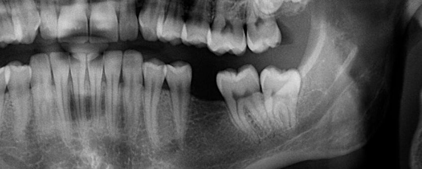 tooth Intrinsic Family Dental