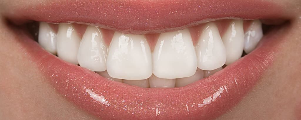 Veneers 11 1024x410 1 Intrinsic Family Dental