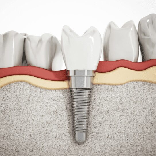 dental implants in huntington woods